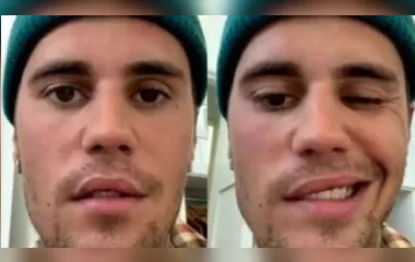 Justin Bieber, de 28 anos, assustou seus seguidores e fãs ao mostrar que metade do seu rosto está paralisado