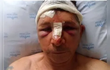 Devido ao acidente, Carlos quebrou o nariz e o maxilar